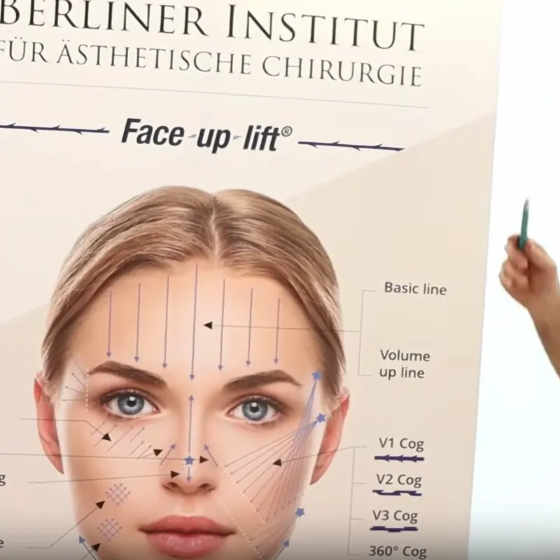 Fadenlifting in Berlin: Behandlungsschema des Face-up-lift bei Dr. med. Karsten Lange